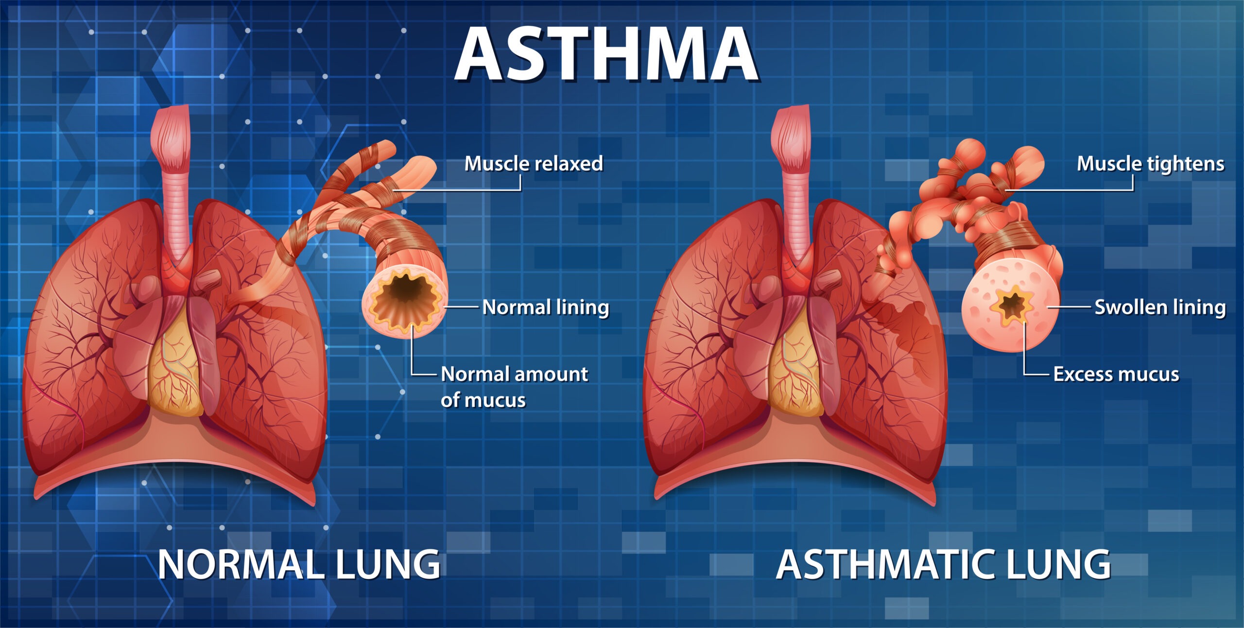 Schaubild Vergleich gesunde und Asthma-Lunge