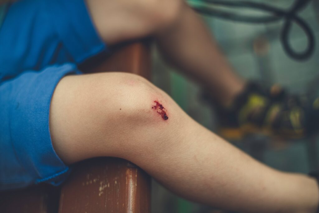 Ein aufgeschürftes Knie bei einem Kind. Bei fortgeschrittener Erkrankung treten häufig Wundheilungsprobleme auf.